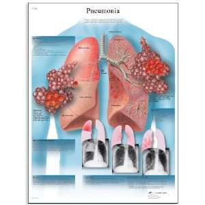  UV Resistant Laminated Paper Pneumonie Allergies Chart (Pneumonia 