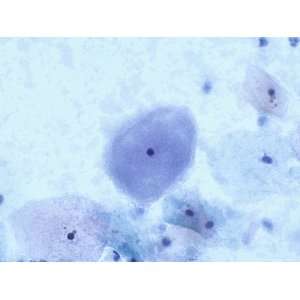  Gardnerella Vaginalis Clue Cells Pap Smear X10 